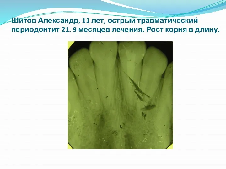 Шитов Александр, 11 лет, острый травматический периодонтит 21. 9 месяцев лечения. Рост корня в длину.