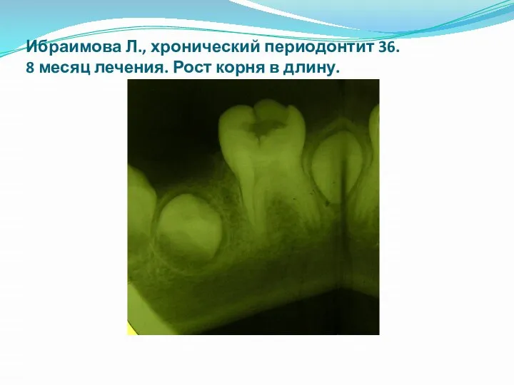 Ибраимова Л., хронический периодонтит 36. 8 месяц лечения. Рост корня в длину.