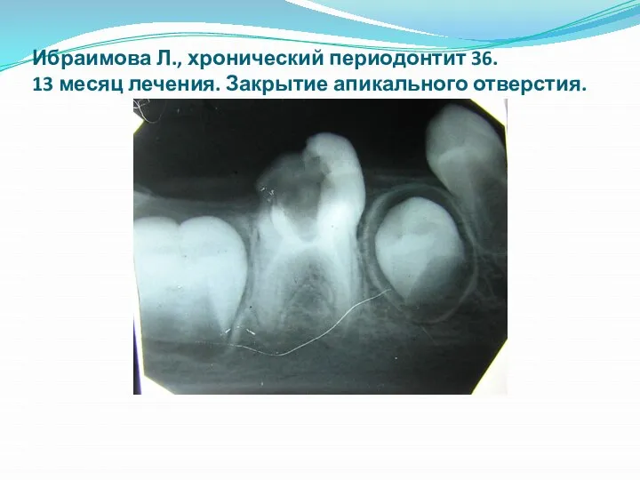 Ибраимова Л., хронический периодонтит 36. 13 месяц лечения. Закрытие апикального отверстия.