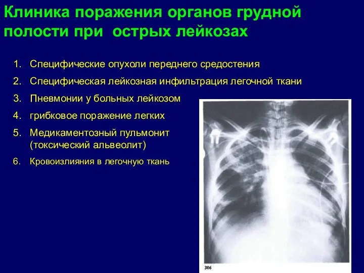 Клиника поражения органов грудной полости при острых лейкозах Специфические опухоли переднего средостения