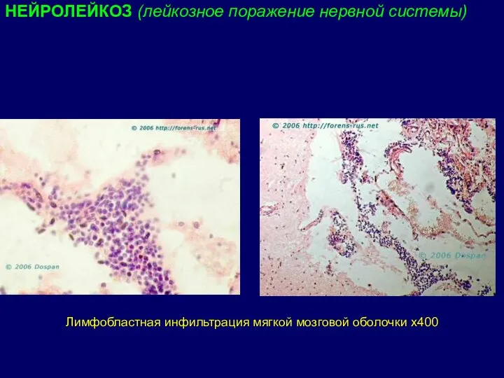 Лимфобластная инфильтрация мягкой мозговой оболочки х400 НЕЙРОЛЕЙКОЗ (лейкозное поражение нервной системы)