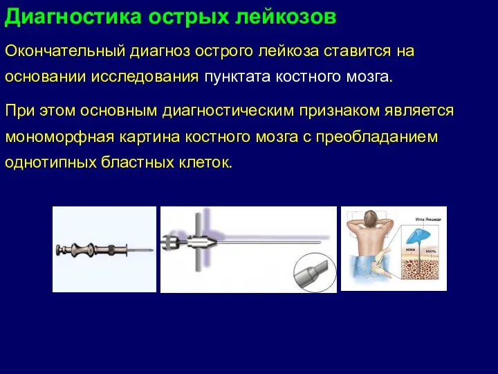 Окончательный диагноз острого лейкоза ставится на основании исследования пунктата костного мозга. При