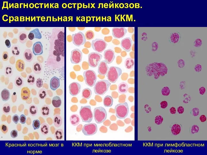 Красный костный мозг в норме ККМ при лимфобластном лейкозе ККМ при миелобластном