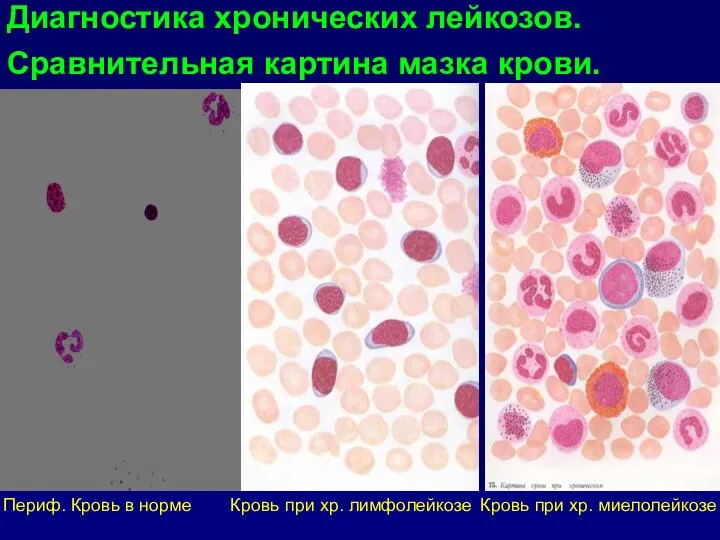 Диагностика хронических лейкозов. Сравнительная картина мазка крови. Периф. Кровь в норме Кровь