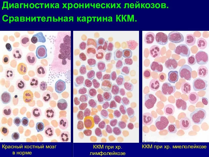 ККМ при хр. лимфолейкозе Красный костный мозг в норме ККМ при хр.