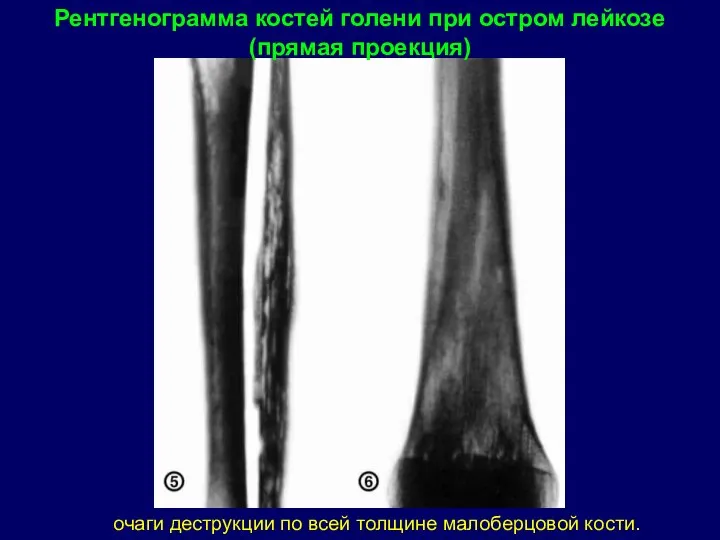 Рентгенограмма костей голени при остром лейкозе (прямая проекция) очаги деструкции по всей толщине малоберцовой кости.