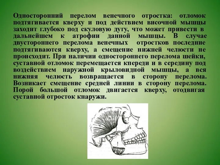 Односторонний перелом венечного отростка: отломок подтягивается кверху и под действием височной мышцы