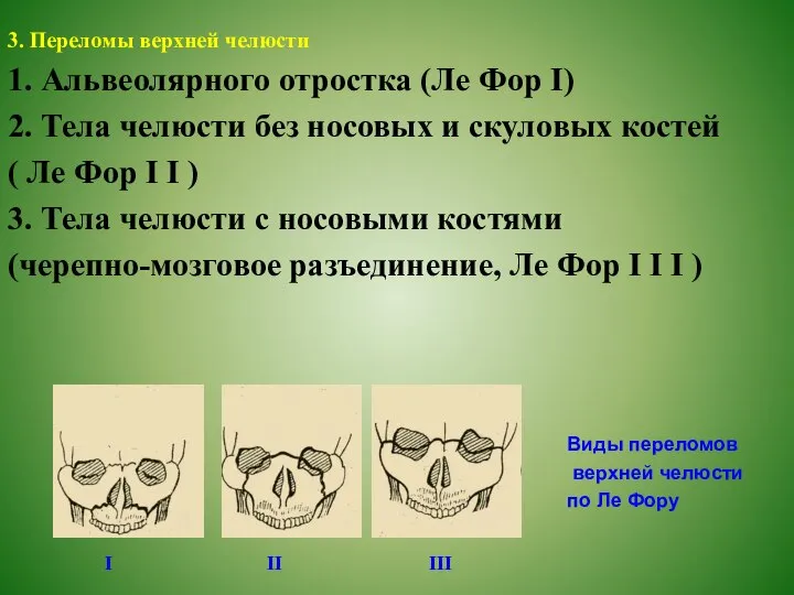 3. Переломы верхней челюсти 1. Альвеолярного отростка (Ле Фор І) 2. Тела