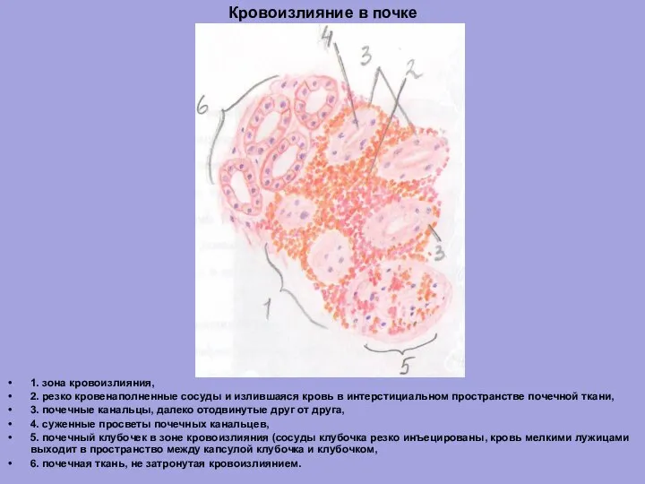 Кровоизлияние в почке 1. зона кровоизлияния, 2. резко кровенаполненные сосуды и излившаяся