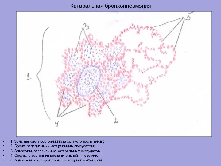 Катаральная бронхопневмония 1. Зона легкого в состоянии катарального воспаления; 2. Бронх, заполненный