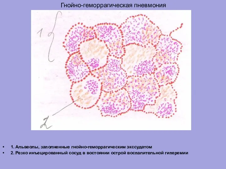 Гнойно-геморрагическая пневмония 1. Альвеолы, заполненные гнойно-геморрагическим экссудатом 2. Резко инъецированный сосуд в востоянии острой воспалительной гиперемии