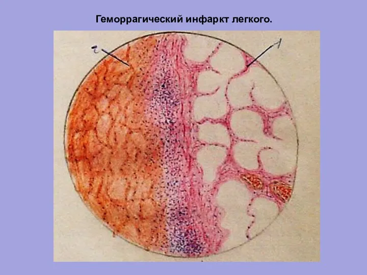 Геморрагический инфаркт легкого.