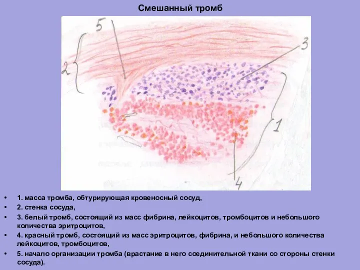 Смешанный тромб 1. масса тромба, обтурирующая кровеносный сосуд, 2. стенка сосуда, 3.