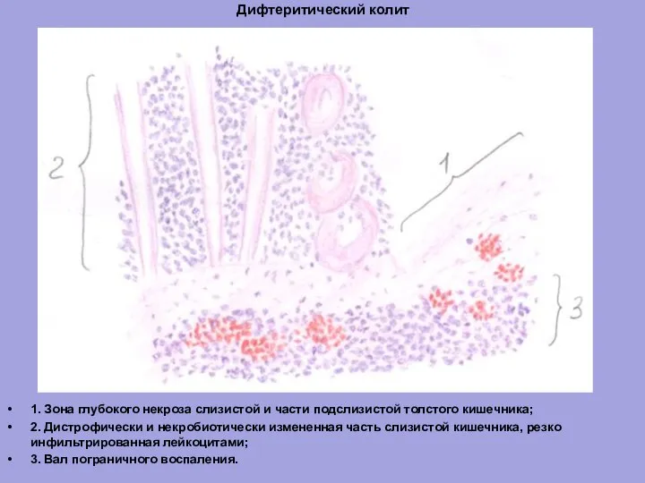 Дифтеритический колит 1. Зона глубокого некроза слизистой и части подслизистой толстого кишечника;
