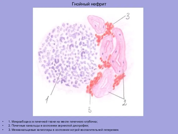 Гнойный нефрит 1. Микроабсцесс в почечной ткани на месте почечного клубочка; 2.