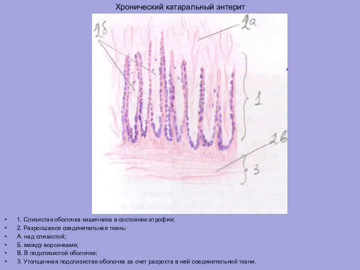 Хронический катаральный энтерит 1. Слизистая оболочка кишечника в состоянии атрофии; 2. Разросшаяся