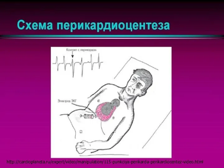 http://cardioplaneta.ru/expert/video/manipulation/115-punkciya-perikarda-perikardiocentez-video.html