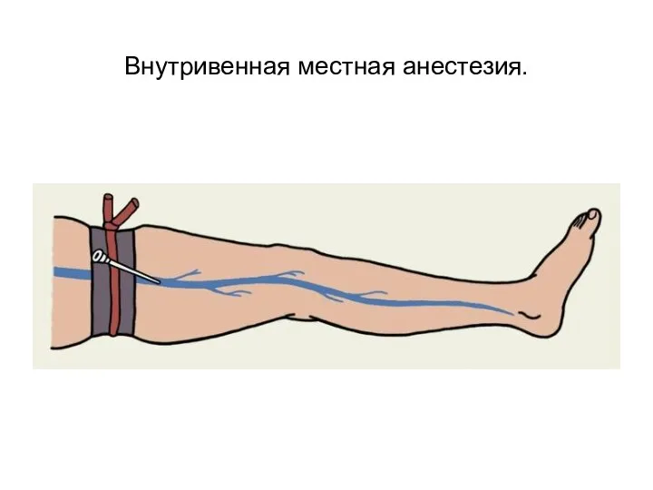 Внутривенная местная анестезия.