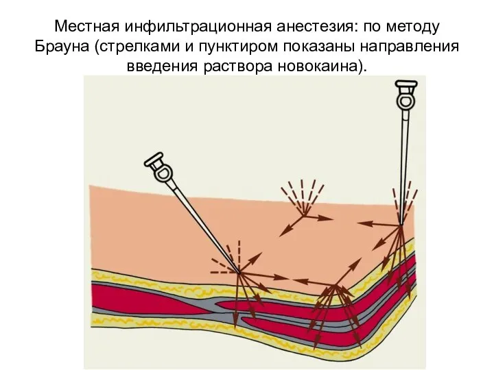 Местная инфильтрационная анестезия: по методу Брауна (стрелками и пунктиром показаны направления введения раствора новокаина).