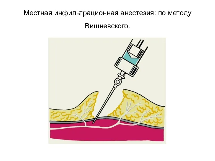 Местная инфильтрационная анестезия: по методу Вишневского.
