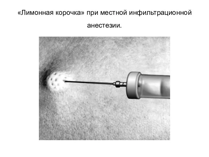 «Лимонная корочка» при местной инфильтрационной анестезии.