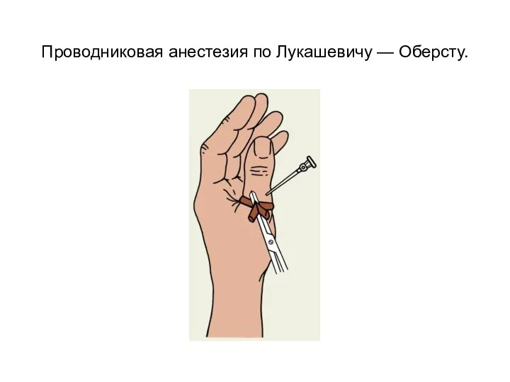 Проводниковая анестезия по Лукашевичу — Оберсту.