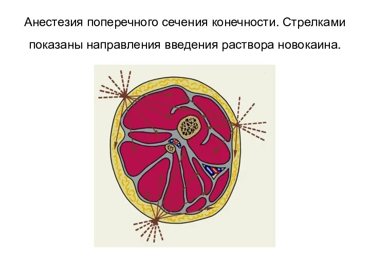 Анестезия поперечного сечения конечности. Стрелками показаны направления введения раствора новокаина.