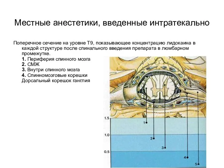 Местные анестетики, введенные интратекально Поперечное сечение на уровне Т9, показывающее концентрацию лидокаина