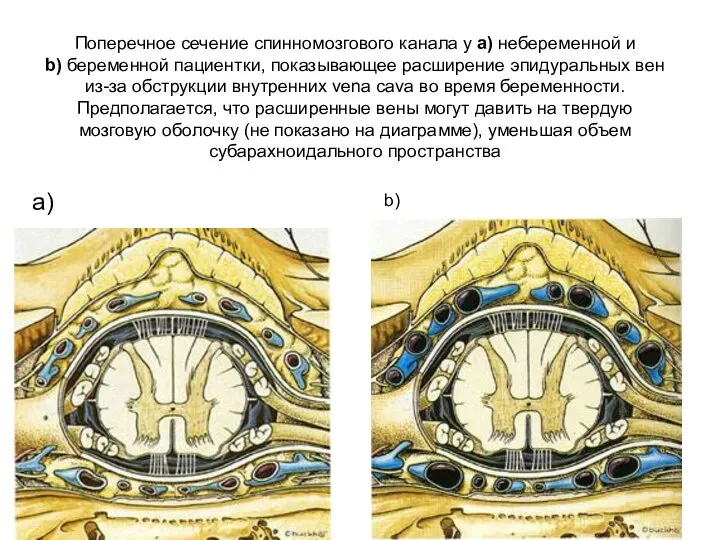 Поперечное сечение спинномозгового канала у а) небеременной и b) беременной пациентки, показывающее