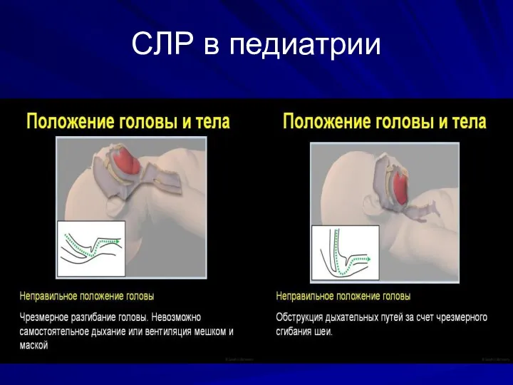 СЛР в педиатрии