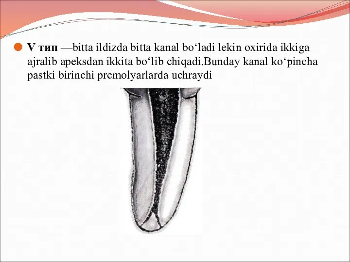 V тип —bitta ildizda bitta kanal boʻladi lekin oxirida ikkiga ajralib apeksdan