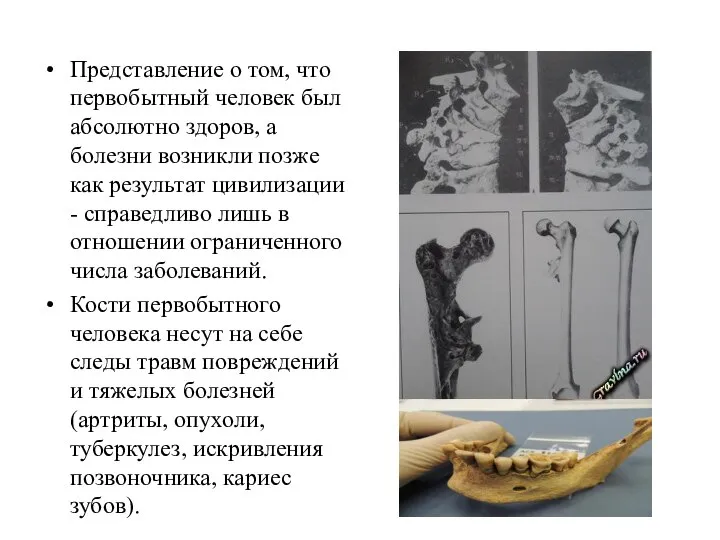 Представление о том, что первобытный человек был абсолютно здоров, а болезни возникли