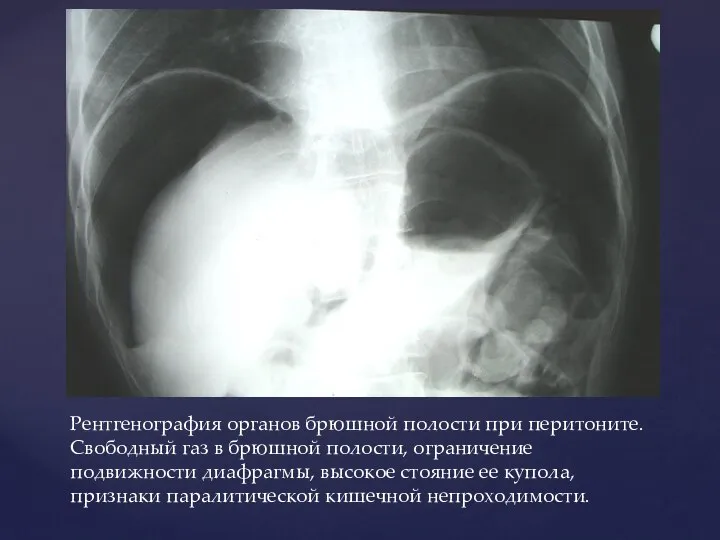 Рентгенография органов брюшной полости при перитоните. Свободный газ в брюшной полости, ограничение