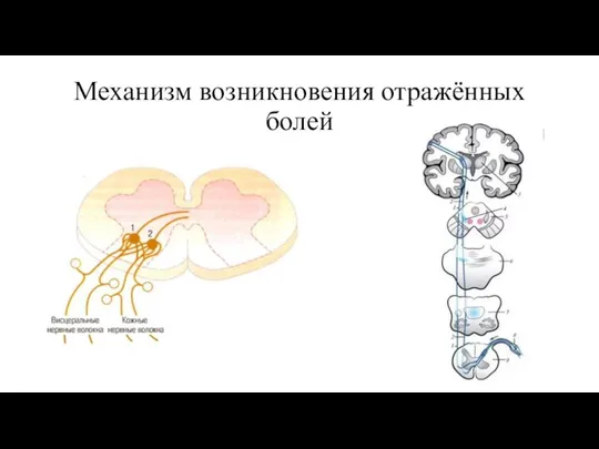 Механизм возникновения отражённых болей