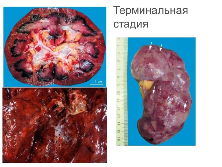 Терминальная стадия