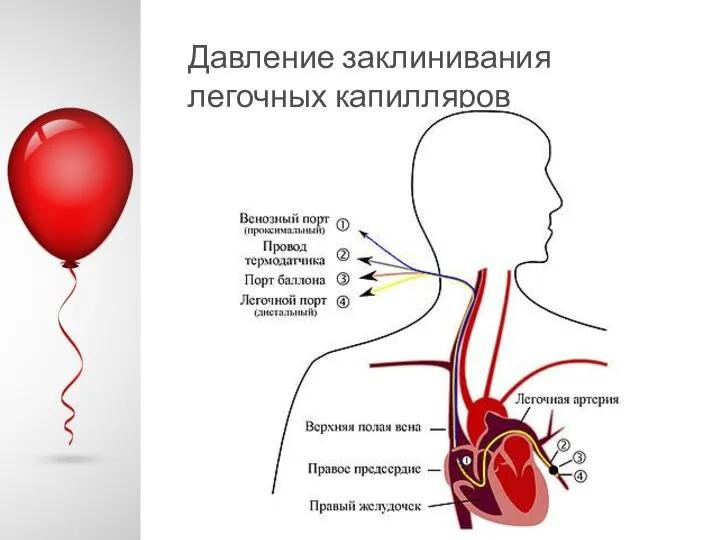 Давление заклинивания легочных капилляров