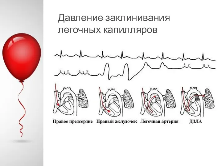 Давление заклинивания легочных капилляров