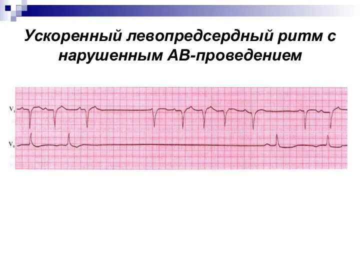 Ускоренный левопредсердный ритм с нарушенным АВ-проведением