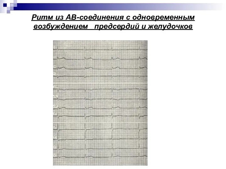 Ритм из АВ-соединения с одновременным возбуждением предсердий и желудочков
