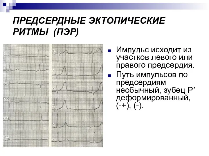 ПРЕДСЕРДНЫЕ ЭКТОПИЧЕСКИЕ РИТМЫ (ПЭР) Импульс исходит из участков левого или правого предсердия.