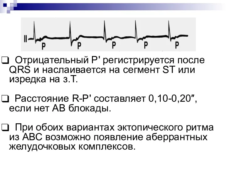 Отрицательный Р' регистрируется после QRS и наслаивается на сегмент ST или изредка