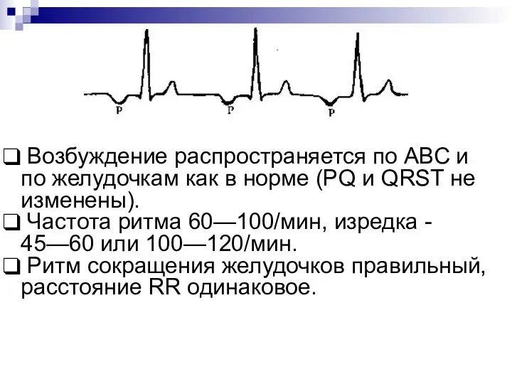 Возбуждение распространяется по АВС и по желудочкам как в норме (PQ и