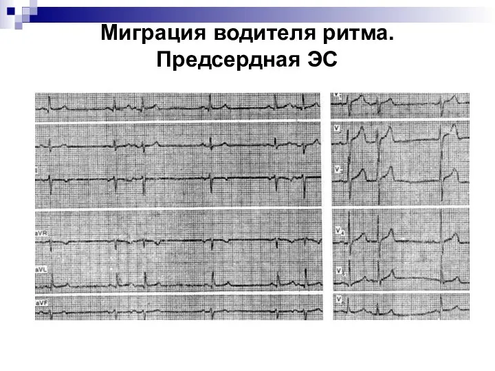 Миграция водителя ритма. Предсердная ЭС