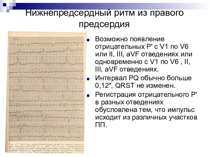 Нижнепредсердный ритм из правого предсердия Возможно появление отрицательных Р' с V1 по