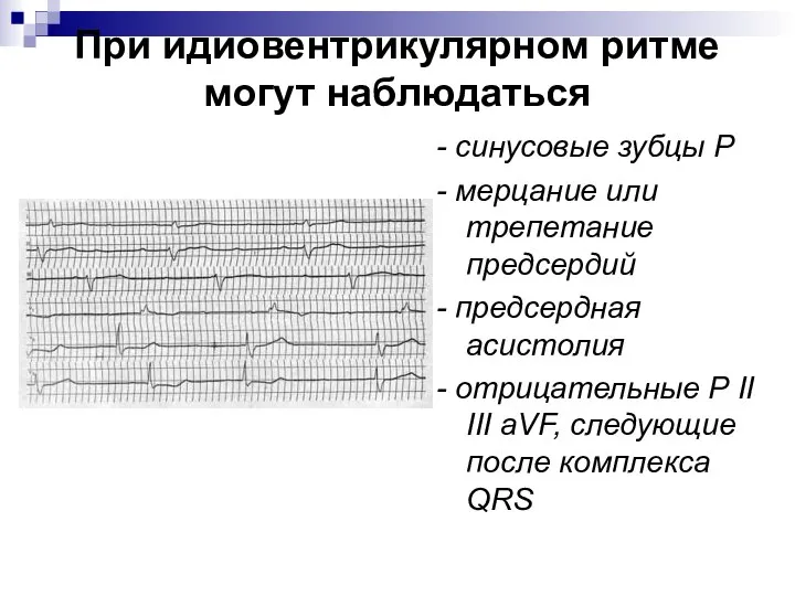 При идиовентрикулярном ритме могут наблюдаться - синусовые зубцы Р - мерцание или