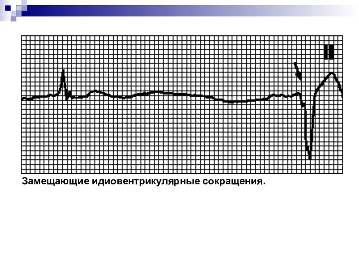 Замещающие идиовентрикулярные сокращения.