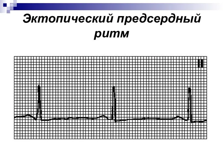 Эктопический предсердный ритм