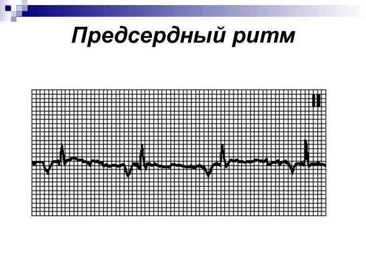 Предсердный ритм