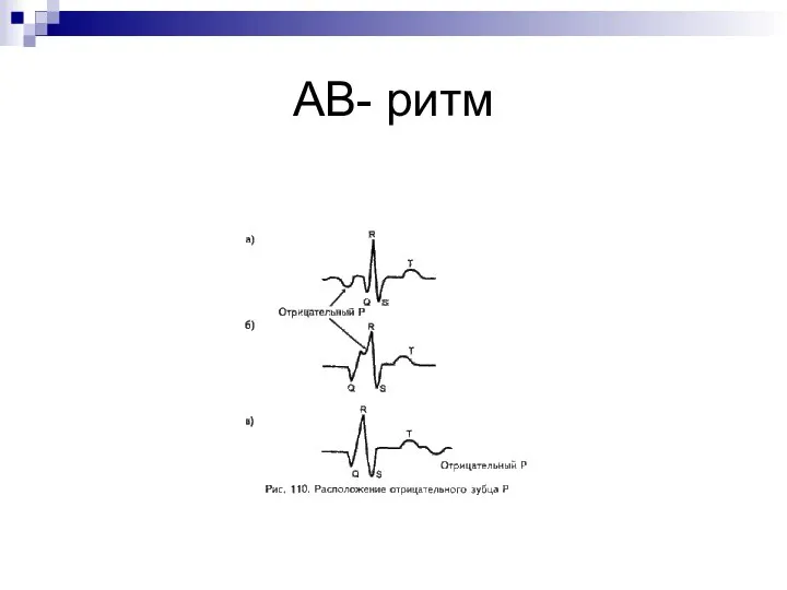 АВ- ритм