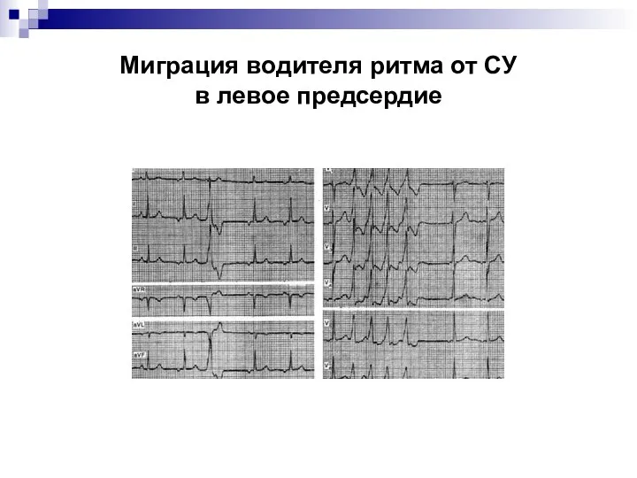 Миграция водителя ритма от СУ в левое предсердие